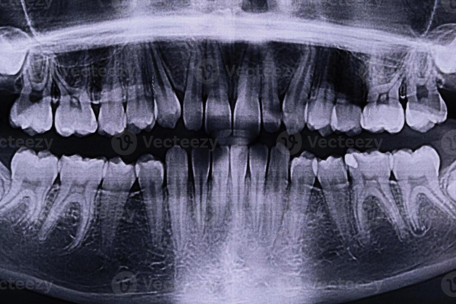 Panoramic X-ray of the jaw. X-ray of the teeth of a 12-year-old girl photo