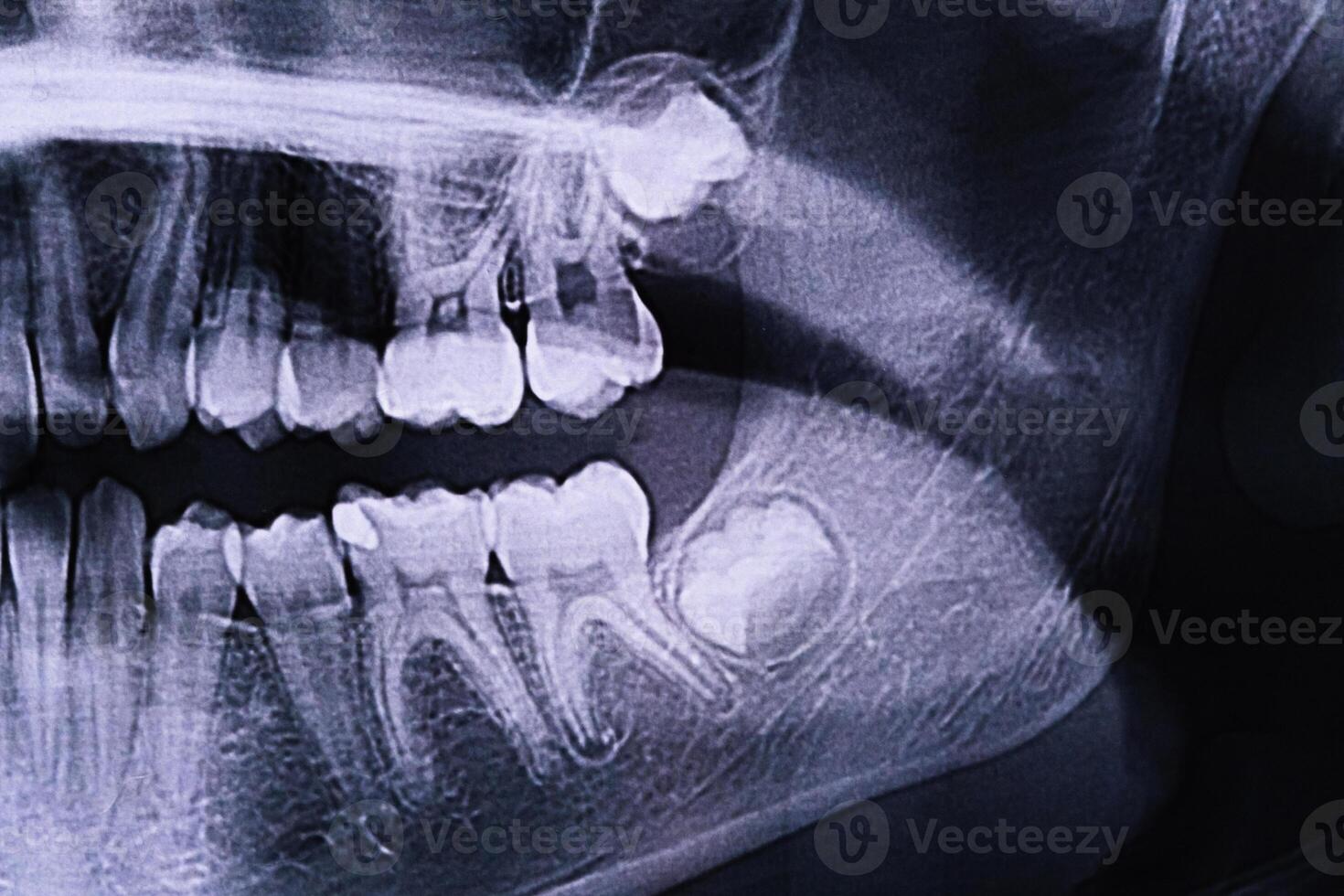 Panoramic X-ray of the jaw. X-ray of the teeth of a 12-year-old girl photo