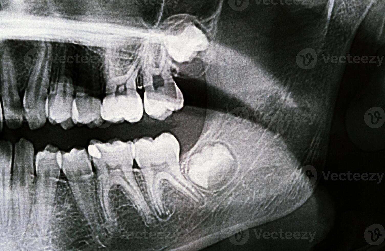 Panoramic X-ray of the jaw. X-ray of the teeth of a 12-year-old girl photo