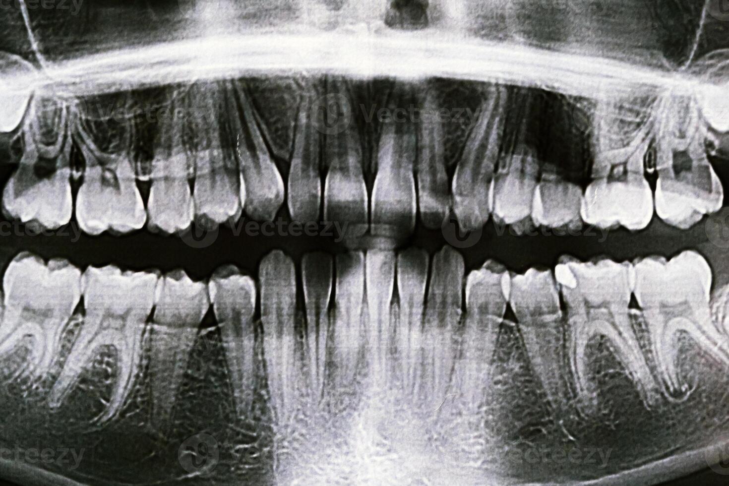 Panoramic X-ray of the jaw. X-ray of the teeth of a 12-year-old girl photo