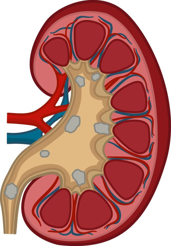 Anatomy of Kidney Stones. Medical Concept of Urinary System Disease. Illustration of Human Internal Organs vector