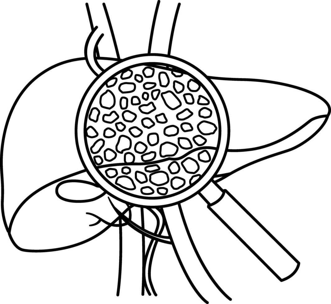 Liver Disease for Coloring Page. Cirrhosis of the Liver under a Magnifying Glass. Illustration of Human Organs. Anatomy and Medicine vector