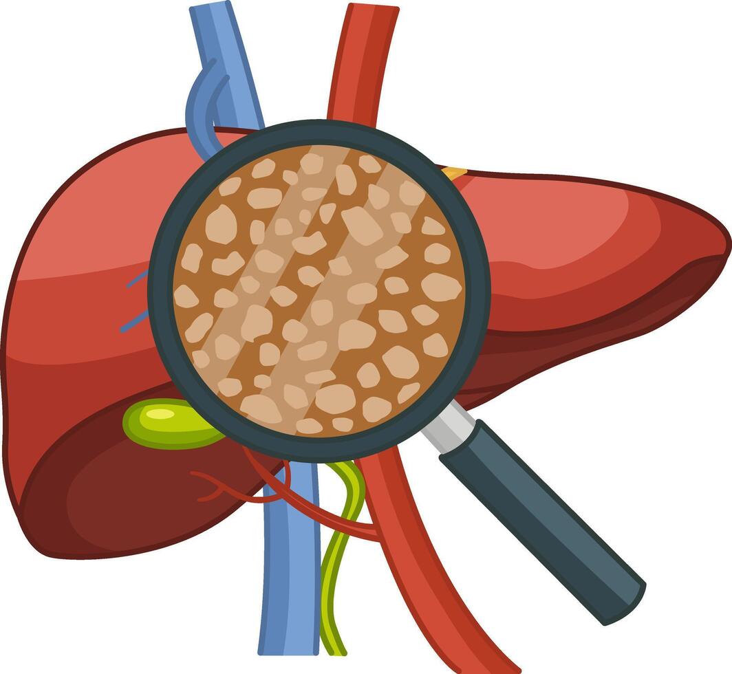 Liver disease. Cirrhosis of the Liver under a Magnifying Glass. Illustration of Human Organs. Anatomy and Medicine vector