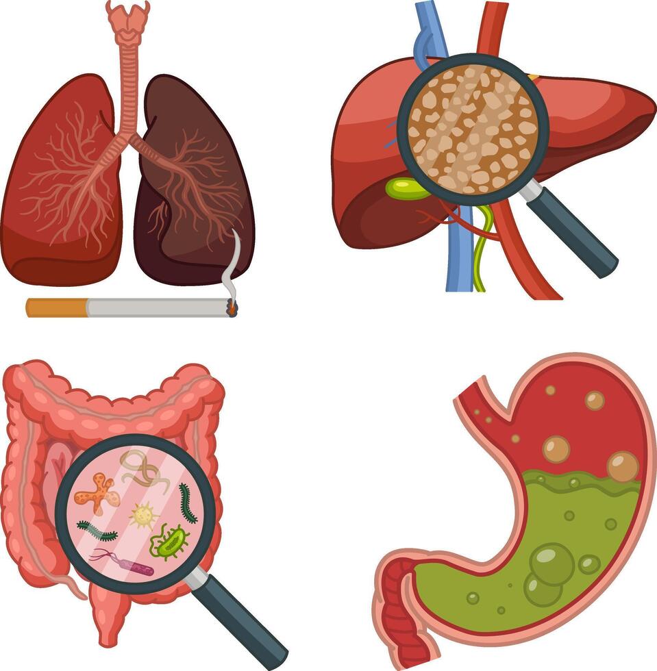 Anatomy of Human Organs with Various Diseases. Illustration of Smoker's Lungs, Liver Hepatitis, Intestinal Virus, and Indigestion. Medicine Concept vector