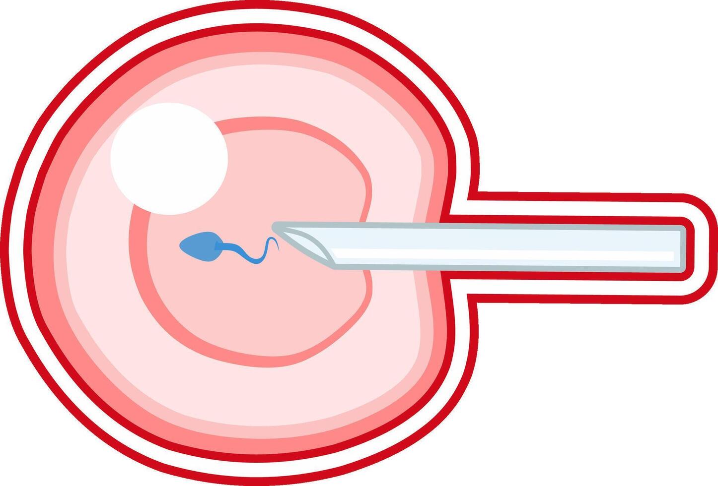 In Vitro fertilization IVF illustration infographic and infertility treatment. Ovarian hyperstimulation, artificial insemination, embryo culture and cryopreservation. Medical procedure for pregnancy vector