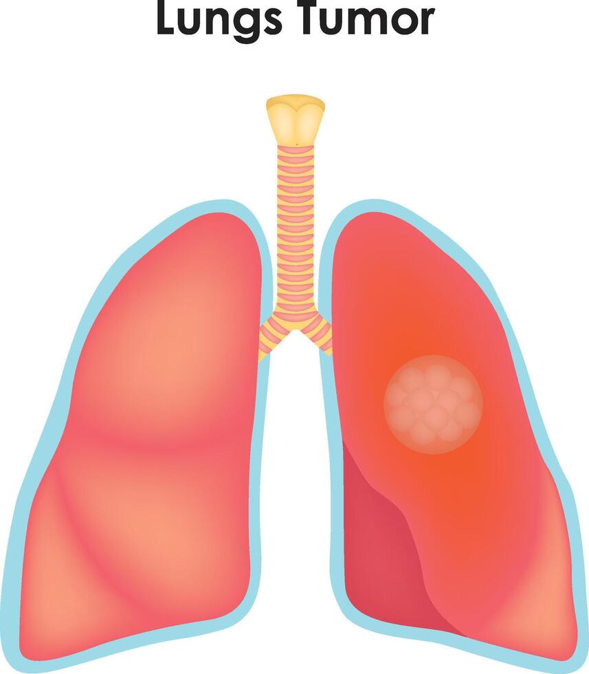 Lungs Tumor Trachea Superior Lobe Bronchi Tumor Inferior Lobe Middle Lobe Left And Right Lobe vector