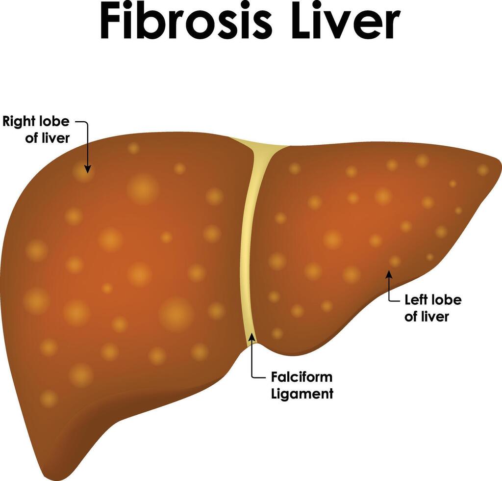 Fibrosis Liver Anatomy Right And Left Lobe of Liver Falciform Ligament Illustration vector
