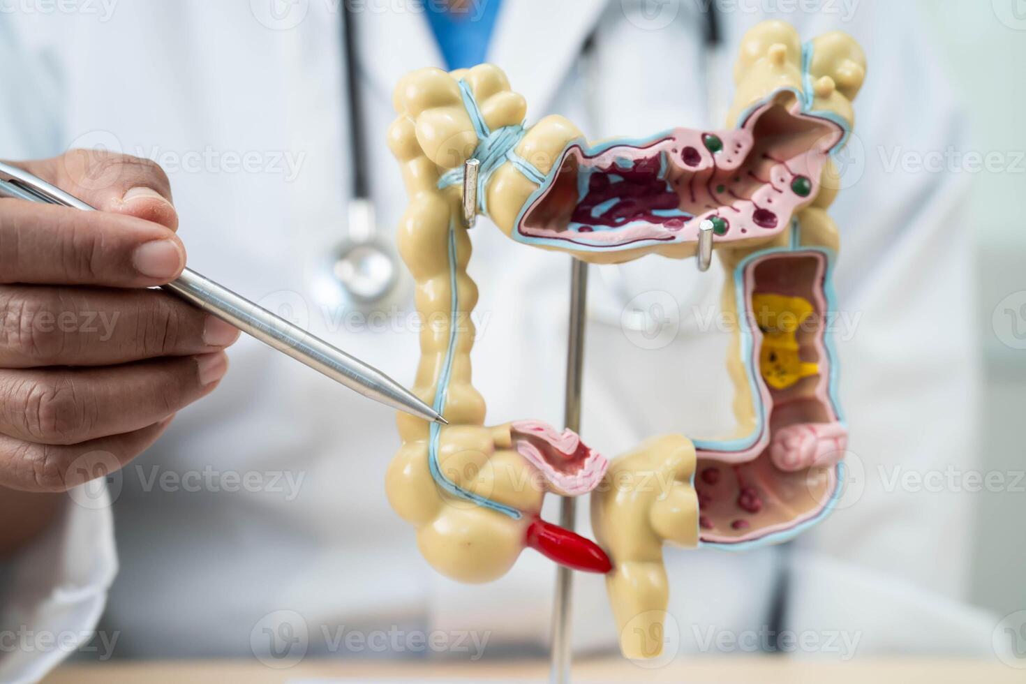 Ulcerative Colitis. Intestine, appendix and digestive system, doctor holding anatomy model for study diagnosis and treatment in hospital. photo