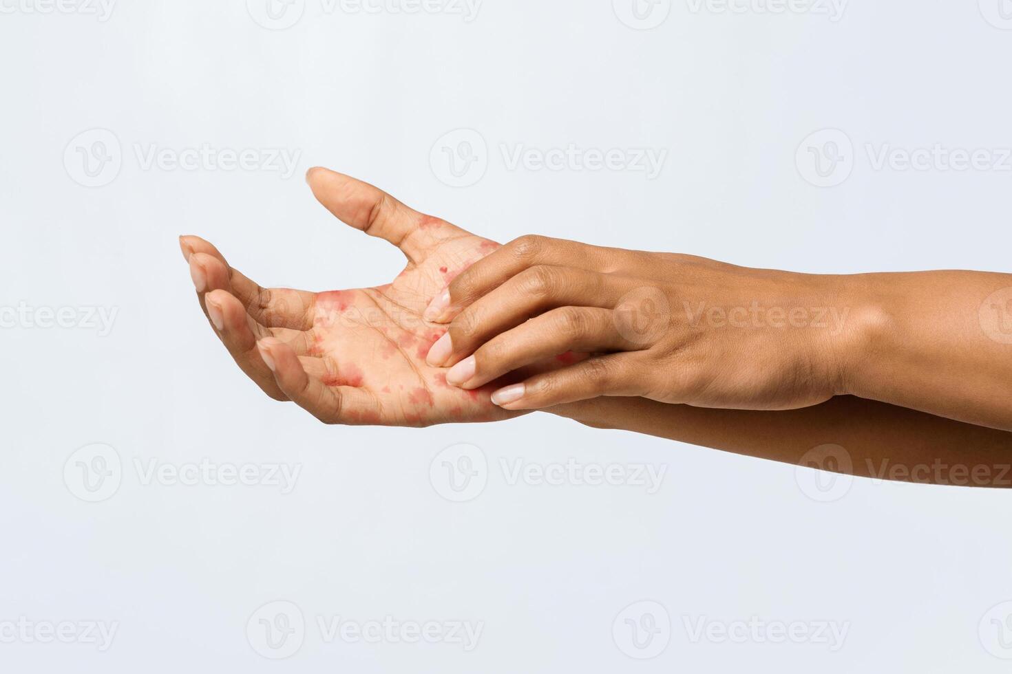 Afro woman having eczema on her palm, rubbing her hand, cropped photo