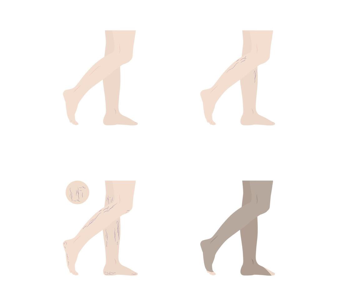 varicose veins period on human leg isolated on background vector