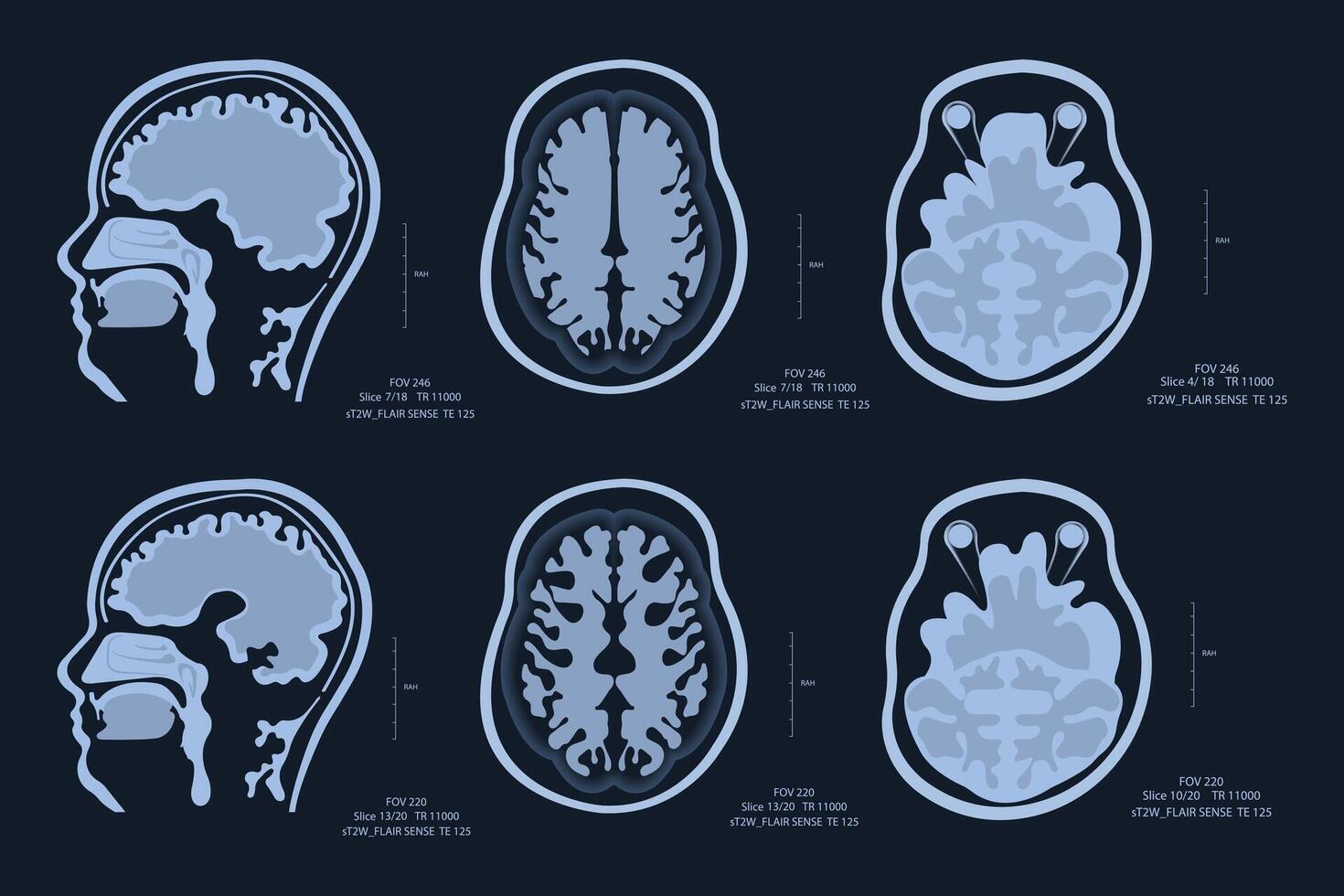 MRI image of a human brain showing all the major manifestations of multiple sclerosis. vector