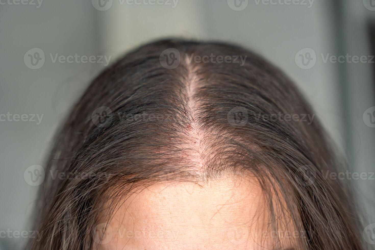 Close-up view of the head with traces of blood from injections after mesotherapy, treatment of alopecia concept photo