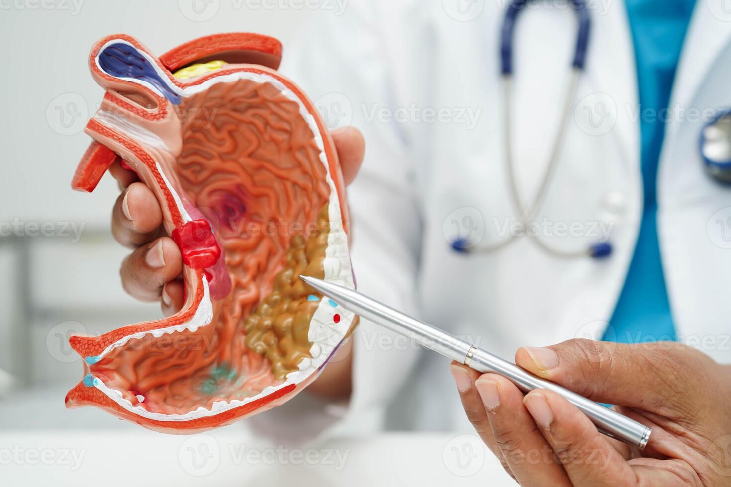 Stomach disease, doctor holding anatomy model for study diagnosis and treatment in hospital. photo