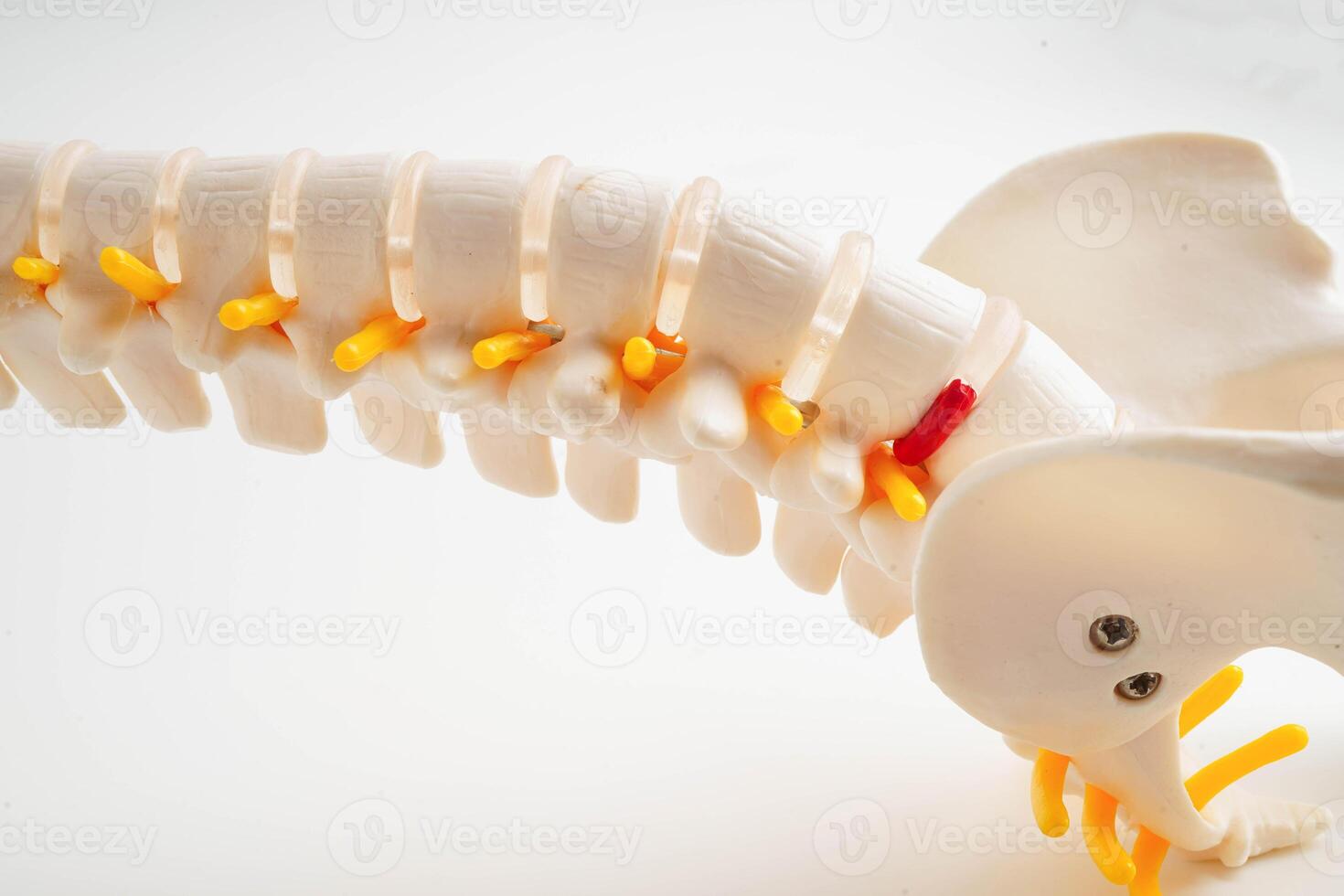 Spinal nerve and bone, Lumbar spine displaced herniated disc fragment, Model for treatment medical in the orthopedic department. photo
