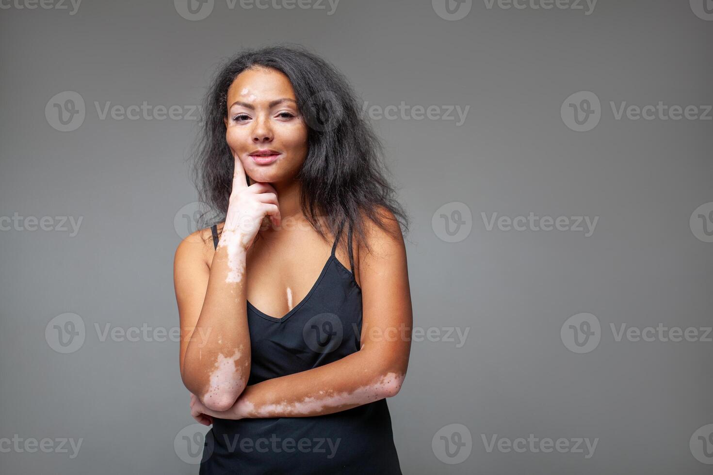 Smiling fashion model with vitiligo skin issue against gray background photo