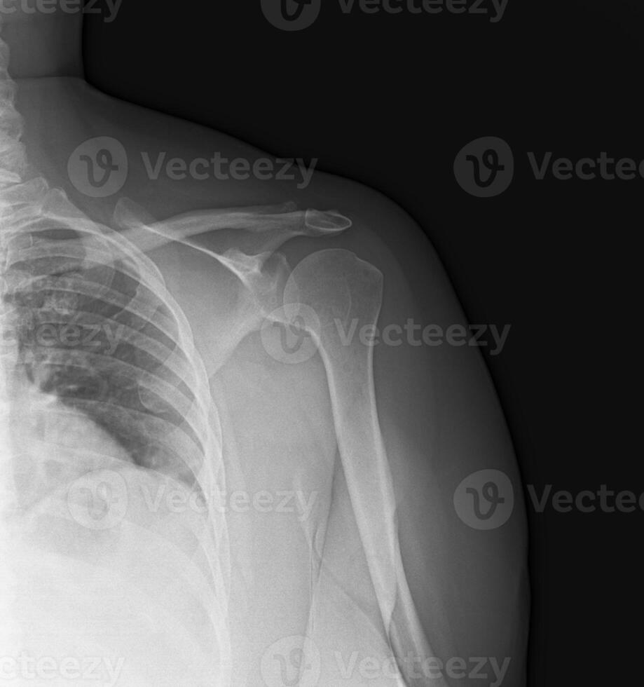 X-ray photo image showing the left shoulder of a woman.