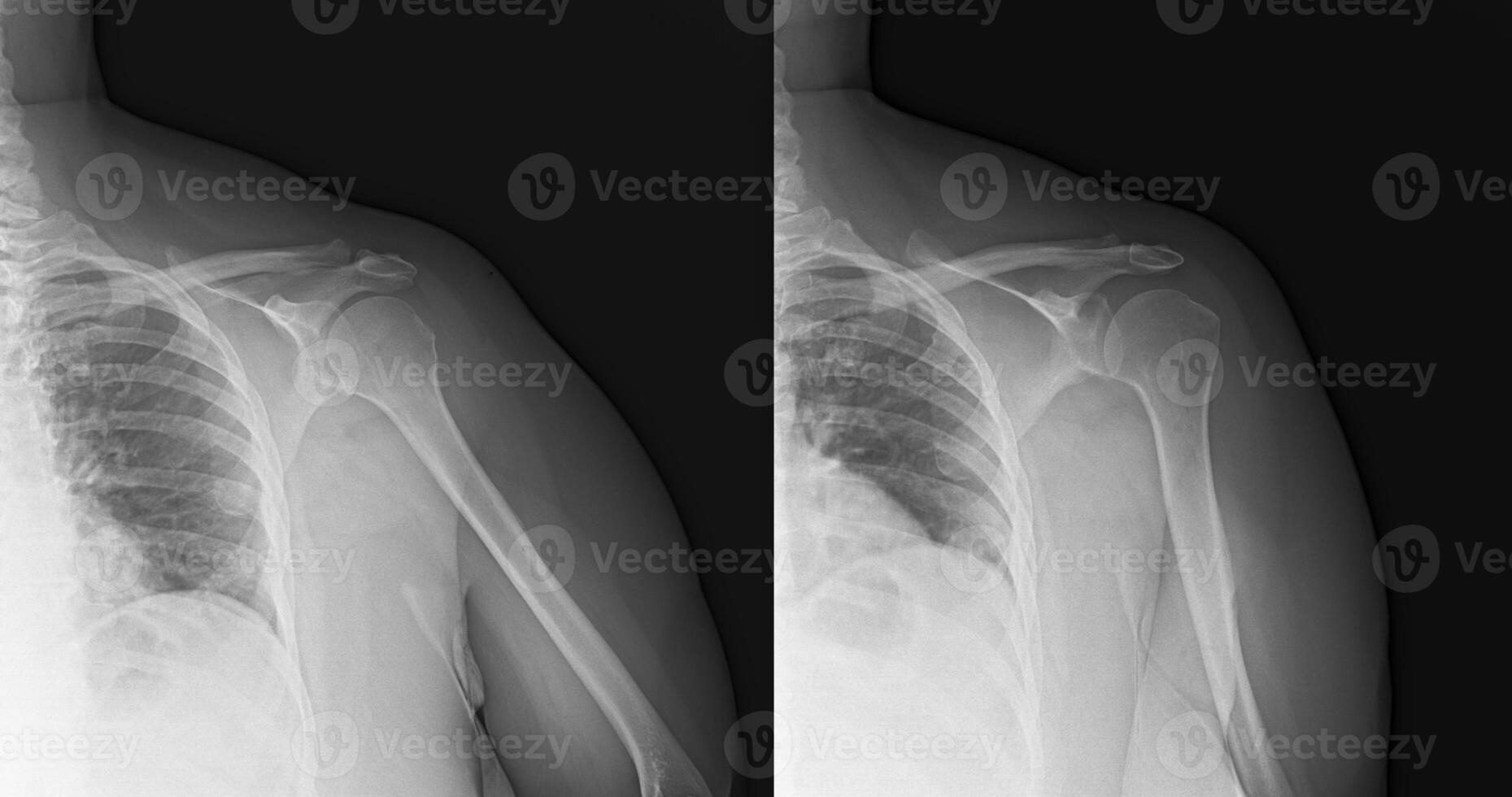 Side by side x-ray photo image showing the left shoulder of a woman.