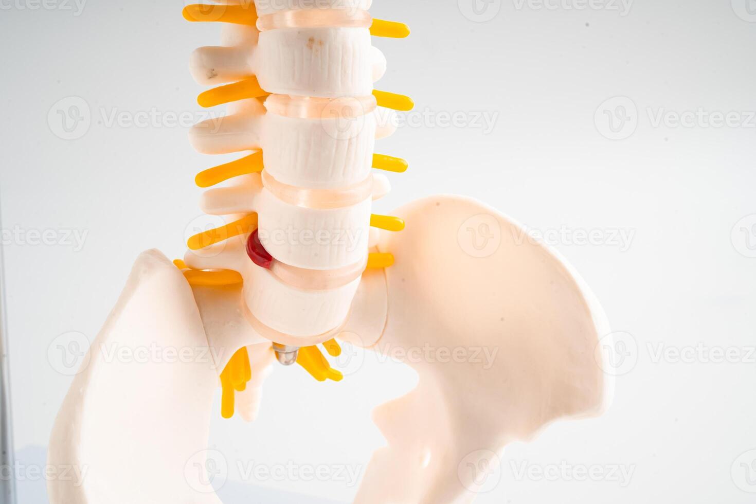 Lumbar spine displaced herniated disc fragment, spinal nerve and bone. Model for treatment medical in the orthopedic department. photo