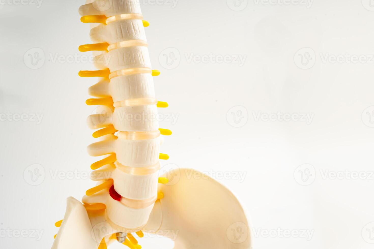 Lumbar spine displaced herniated disc fragment, spinal nerve and bone. Model for treatment medical in the orthopedic department. photo