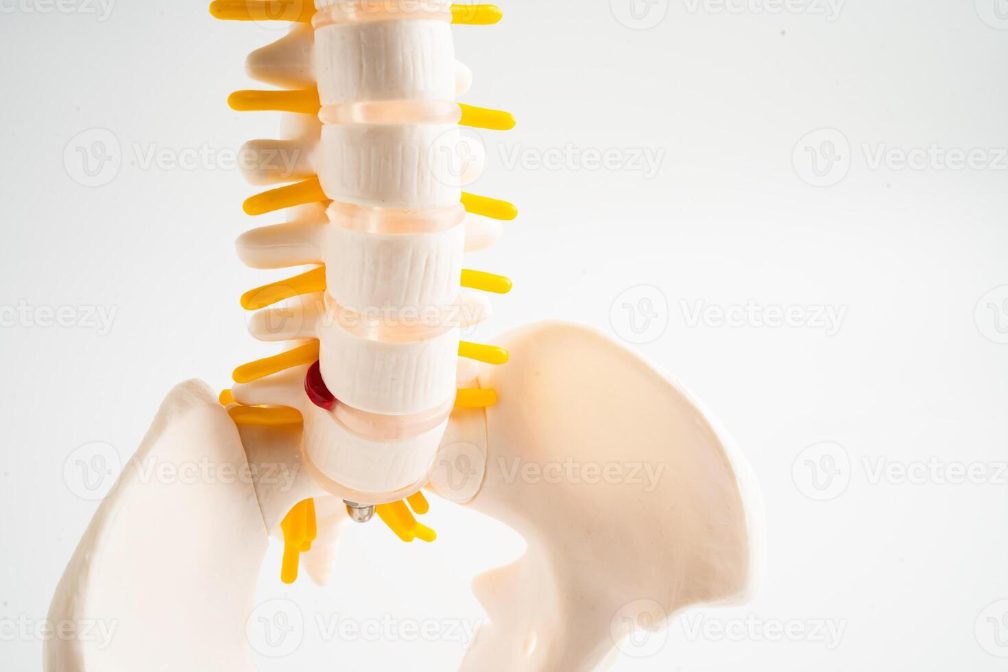 Lumbar spine displaced herniated disc fragment, spinal nerve and bone. Model for treatment medical in the orthopedic department. photo