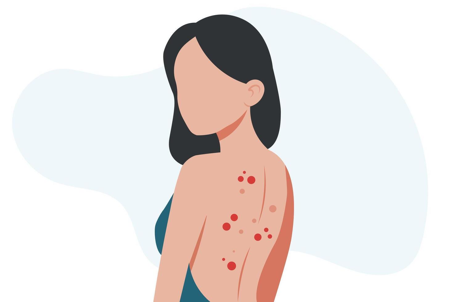 Health problem, skin diseases. Young woman showing her back girl scratching her shoulder with pimples illustration vector