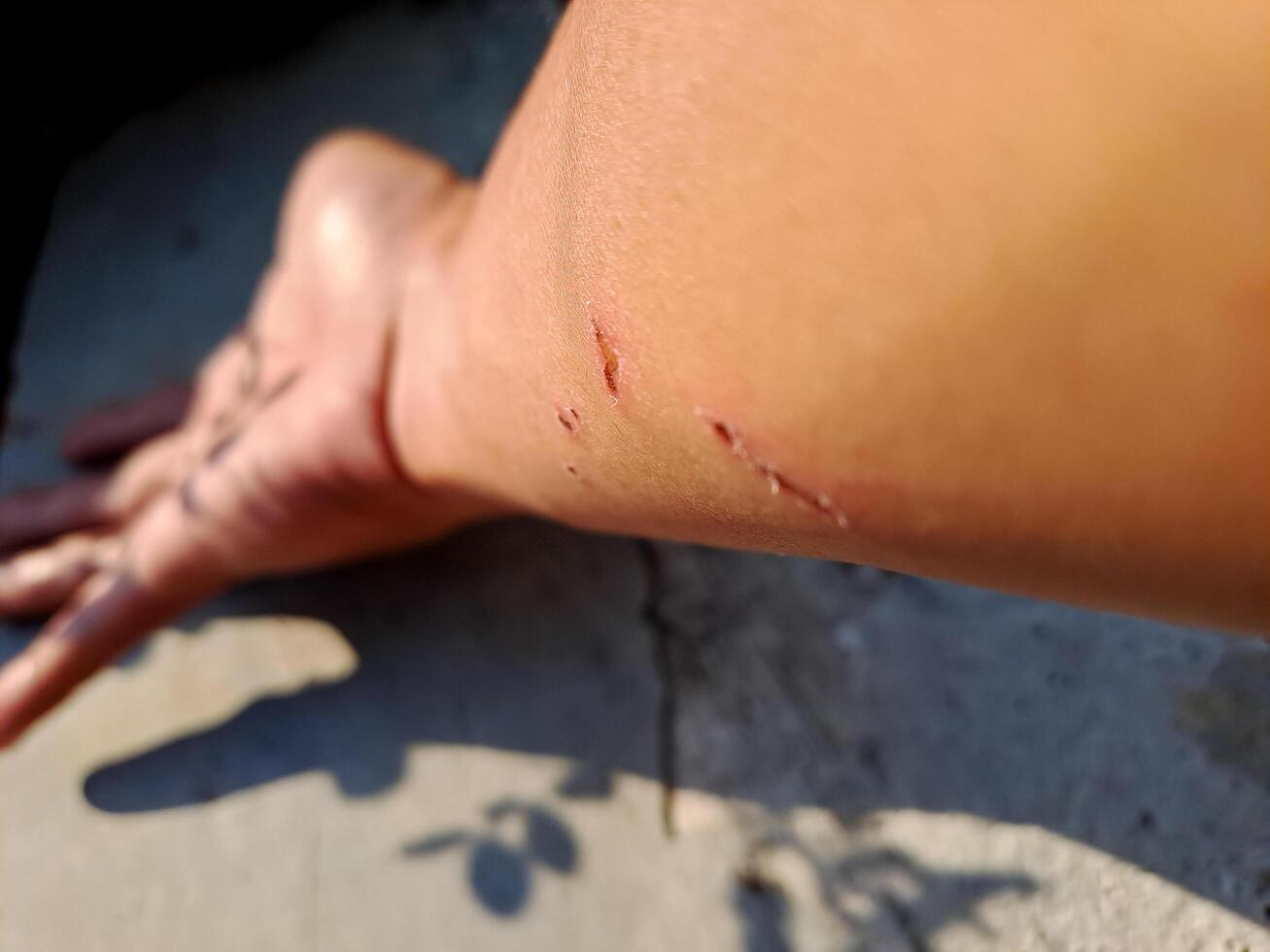 shot of a healing arm with fresh scratches, captured in natural outdoor light. Perfect for health, injury, and recovery themes. photo