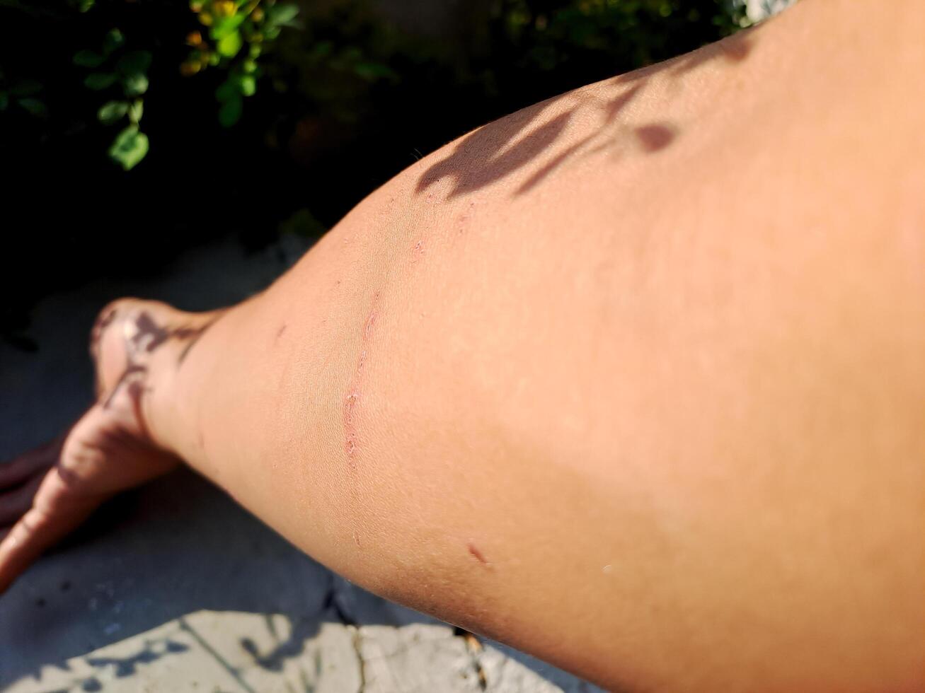 shot of a healing arm with fresh scratches, captured in natural outdoor light. Perfect for health, injury, and recovery themes. photo