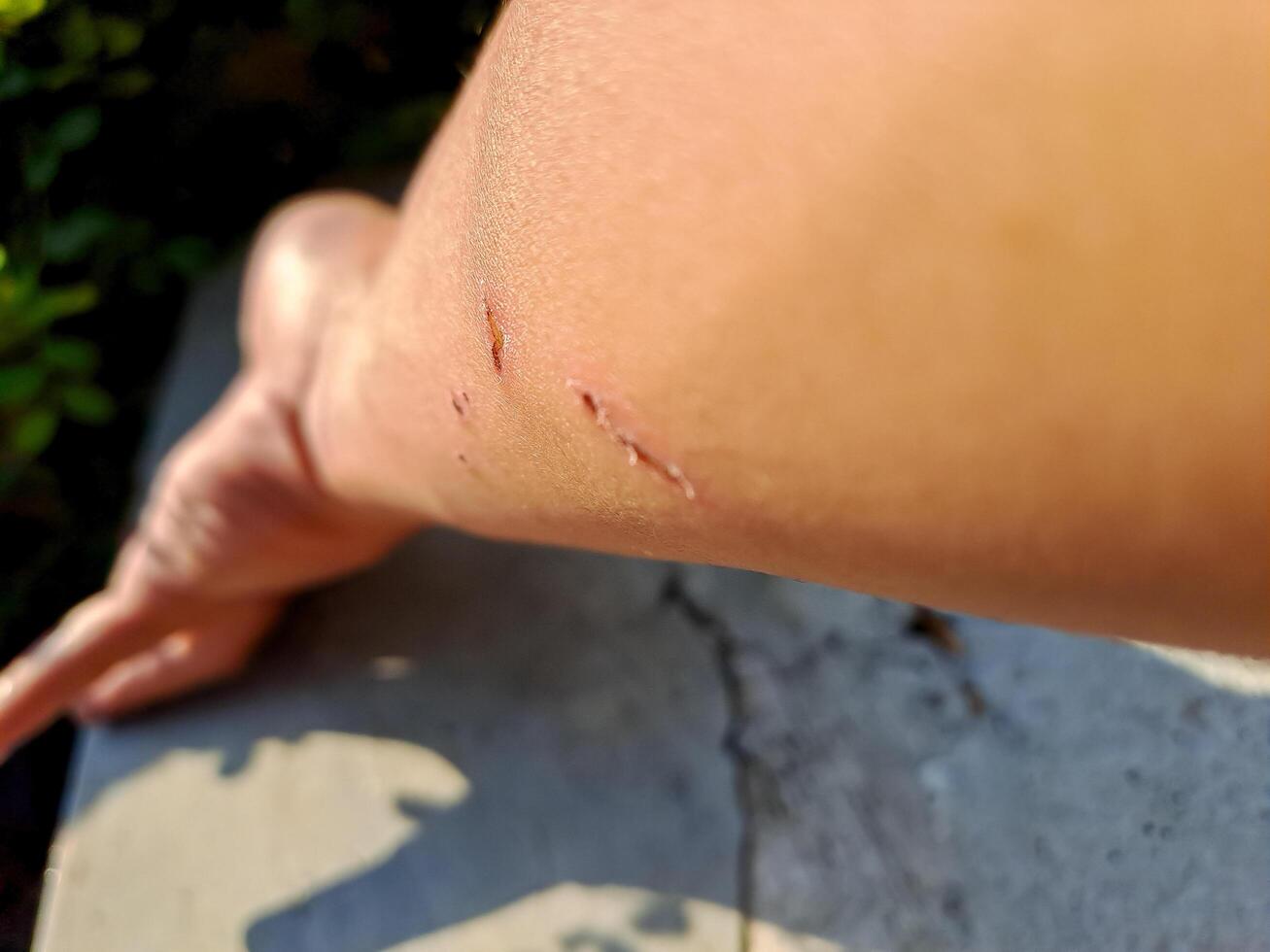 shot of a healing arm with fresh scratches, captured in natural outdoor light. Perfect for health, injury, and recovery themes. photo