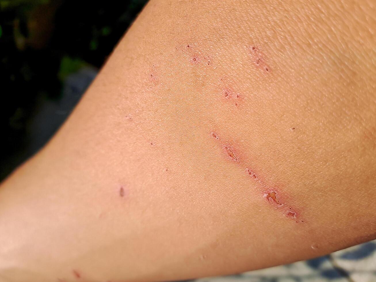 shot of a healing arm with fresh scratches, captured in natural outdoor light. Perfect for health, injury, and recovery themes. photo