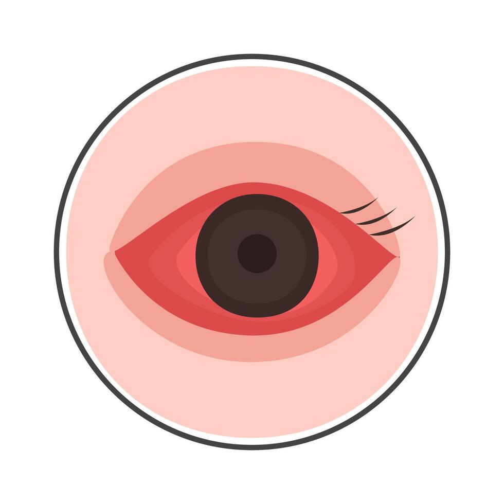 conjunctivitis eyes allergy infection disease vector
