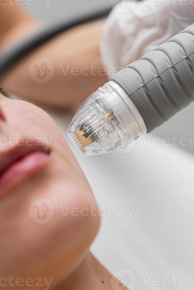 Microneedle RF lifting procedure. Hardware cosmetology. photo