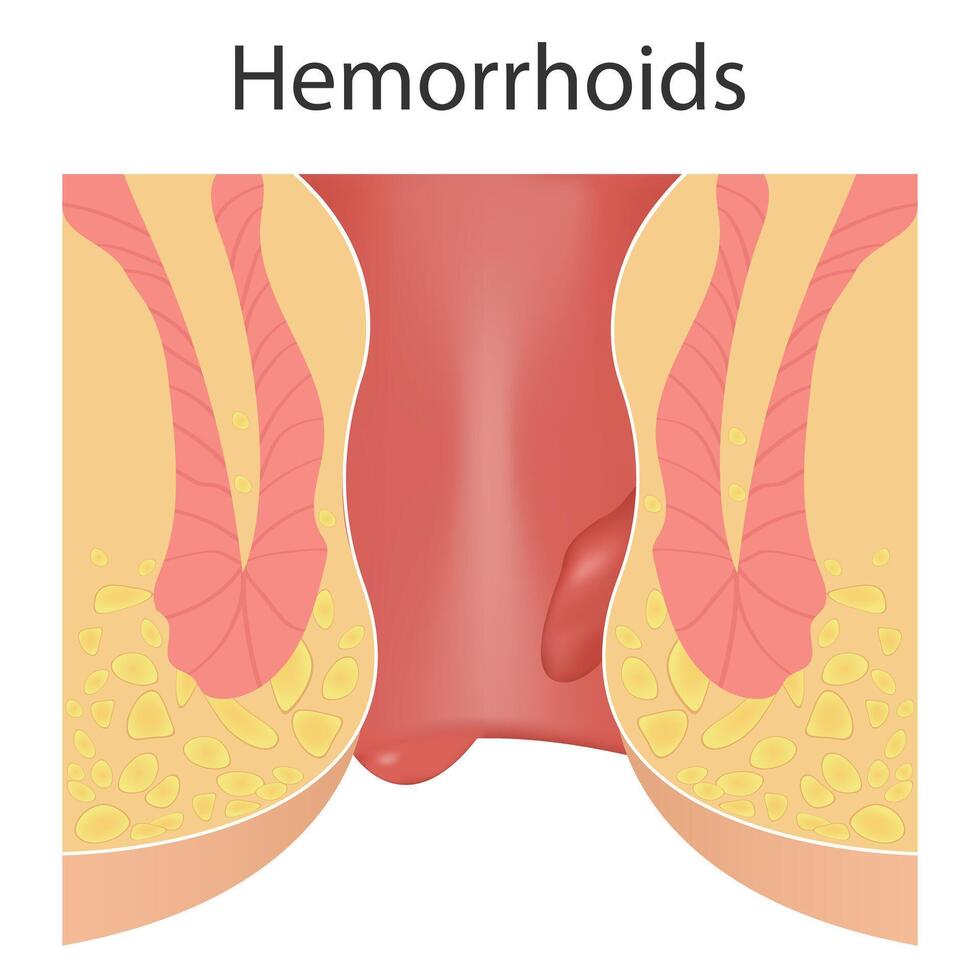 Internal hemorrhoids and external hemorrhoids. Hemorrhoidal disease of the anus, inflammation causes bleeding vector
