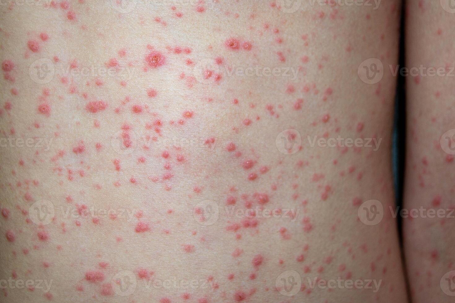 Varicella virus or Chickenpox bubble rash on child photo