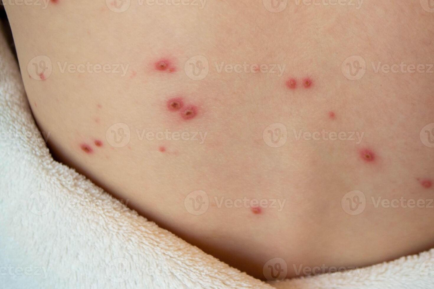 Natural vaccination. Contagious disease. photo