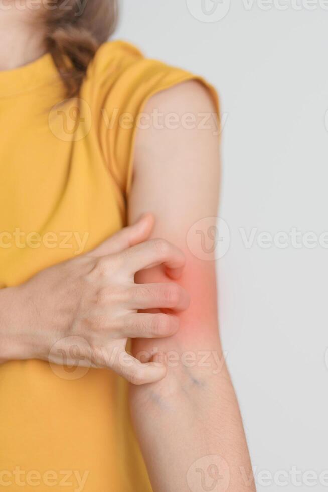 woman itching and scratching itchy arm. Sensitive Skin Allergic reaction to insect bite, food, drug dermatitis. Dermatology, Leprosy day, Systemic lupus erythematosus, Allergy symptoms and rash Eczema photo