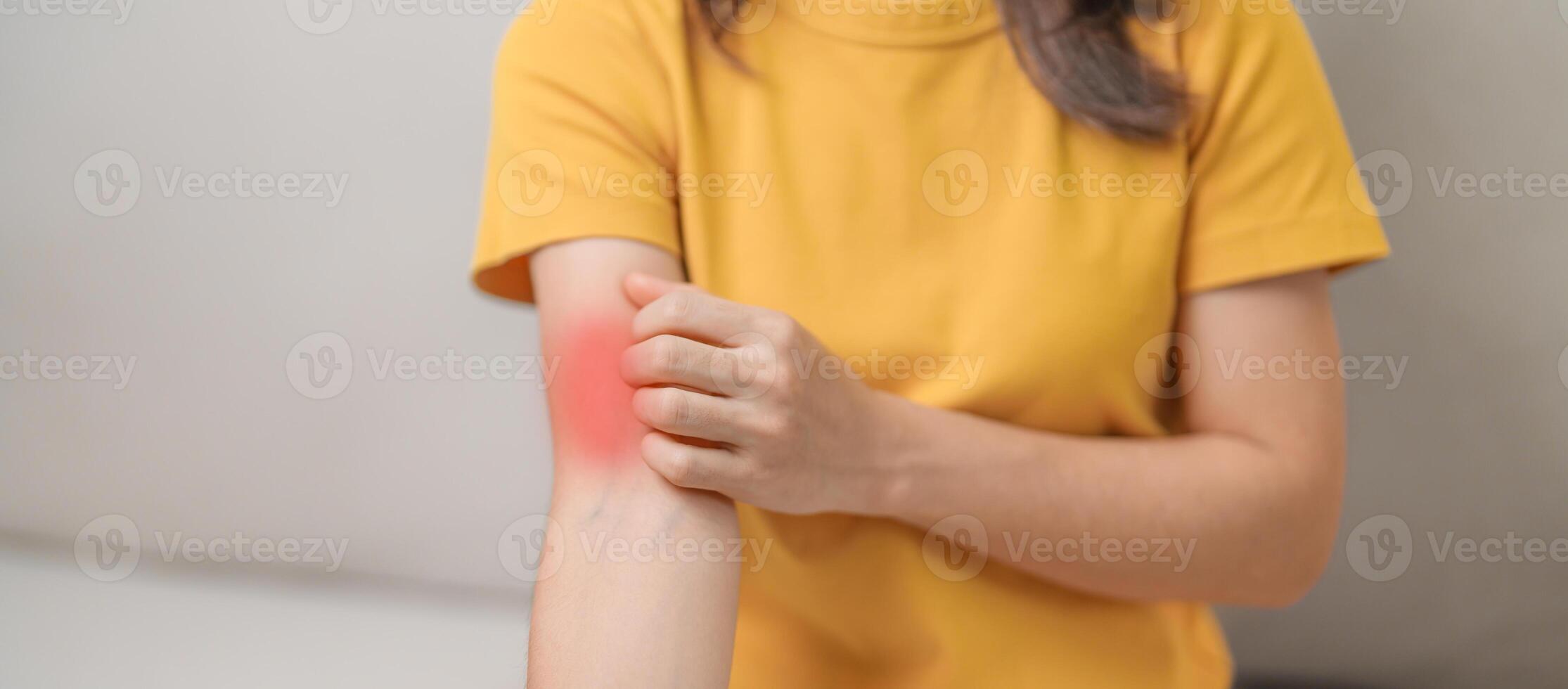 woman itching and scratching itchy arm. Sensitive Skin Allergic reaction to insect bite, food, drug dermatitis. Dermatology, Leprosy day, Systemic lupus erythematosus, Allergy symptoms and rash Eczema photo