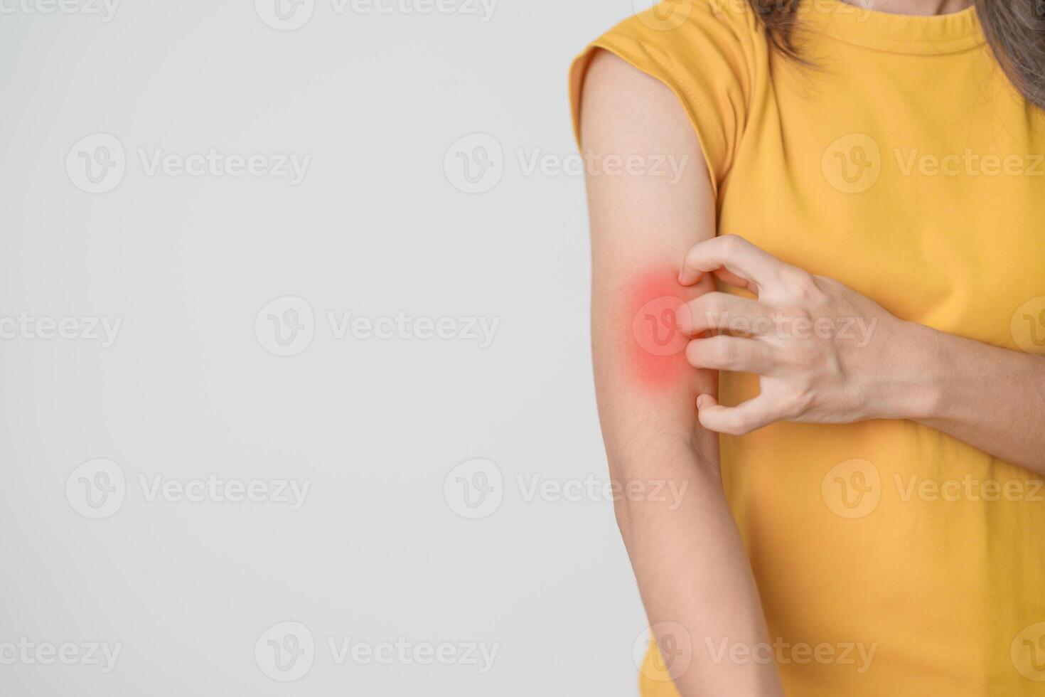woman itching and scratching itchy arm. Sensitive Skin Allergic reaction to insect bite, food, drug dermatitis. Dermatology, Leprosy day, Systemic lupus erythematosus, Allergy symptoms and rash Eczema photo