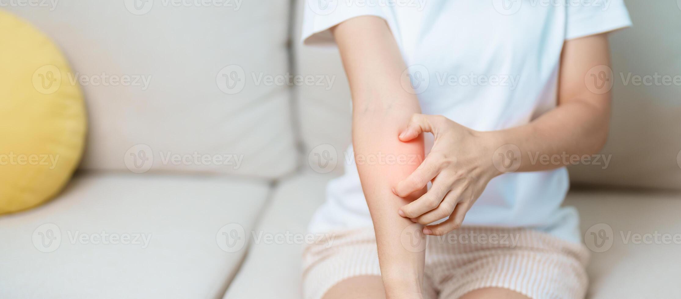 woman itching and scratching itchy arm. Sensitive Skin Allergic reaction to insect bite, food, drug dermatitis. Dermatology, Leprosy day, Systemic lupus erythematosus, Allergy symptoms and rash Eczema photo