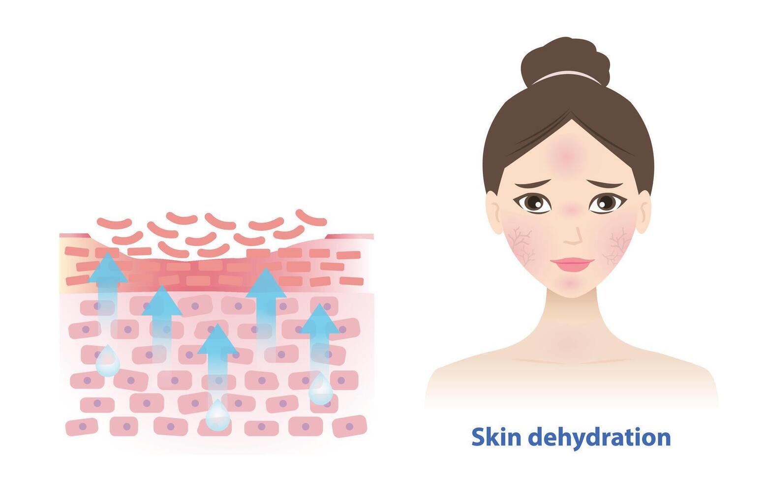 The woman with skin dehydration illustration. Cross section of dry skin barrier layer lead to more water leaving skin and lacks water in the uppermost layer. Skin care and beauty concept. vector