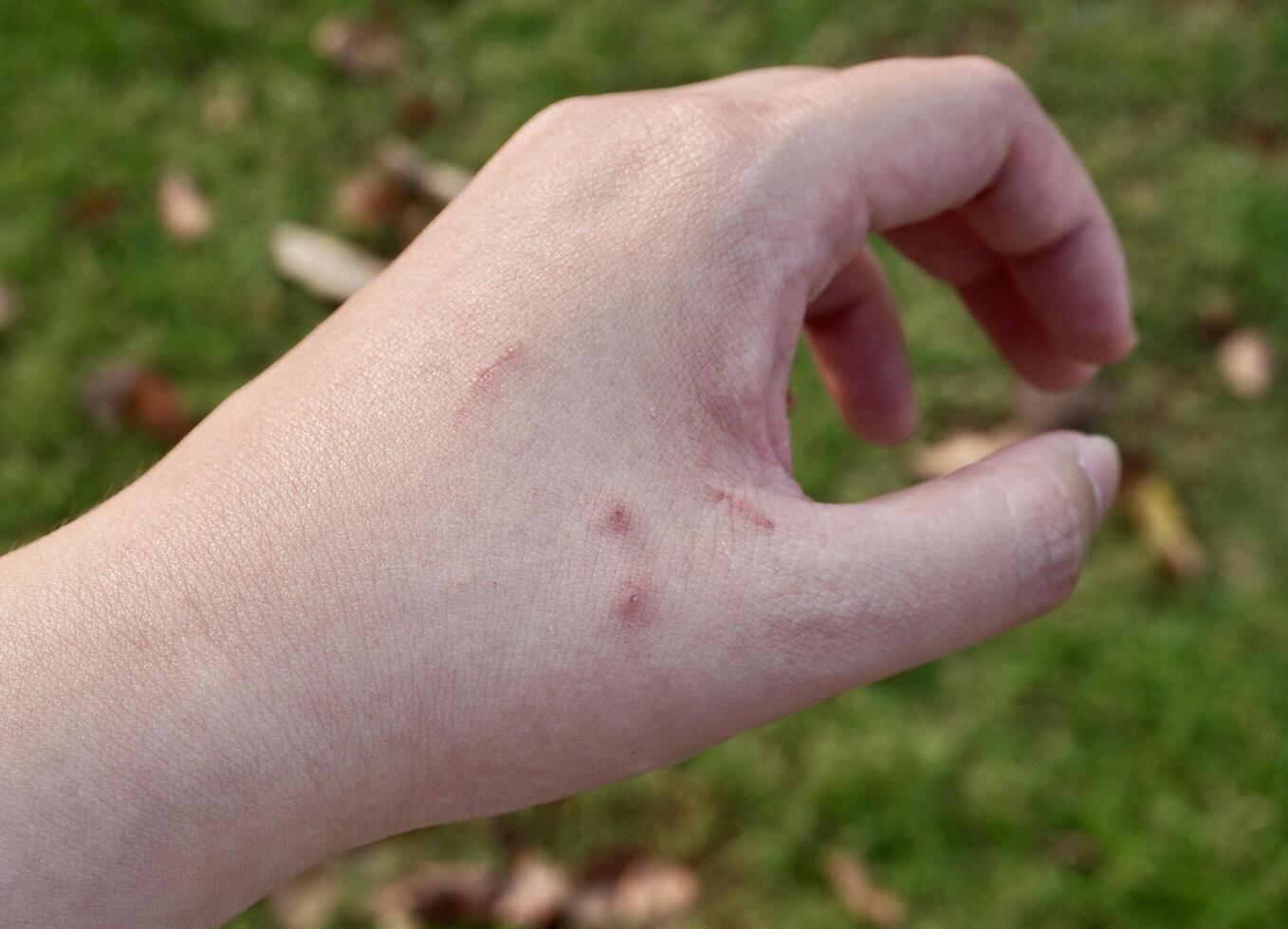 Small scars on human hand from cat claws isolated on horizontal ratio outdoor green grasses and dry leaves background. photo