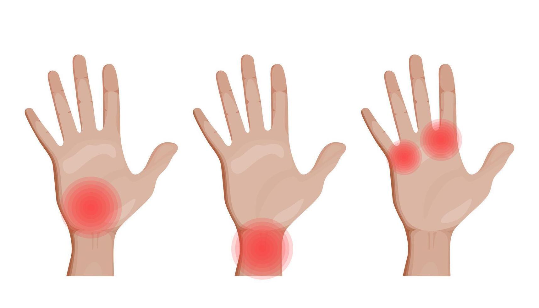 Depicting various types of hand pain. Wrist, finger, and joint discomfort. Medical and healthcare, symptoms of inflammation, numbness, and stiffness. vector