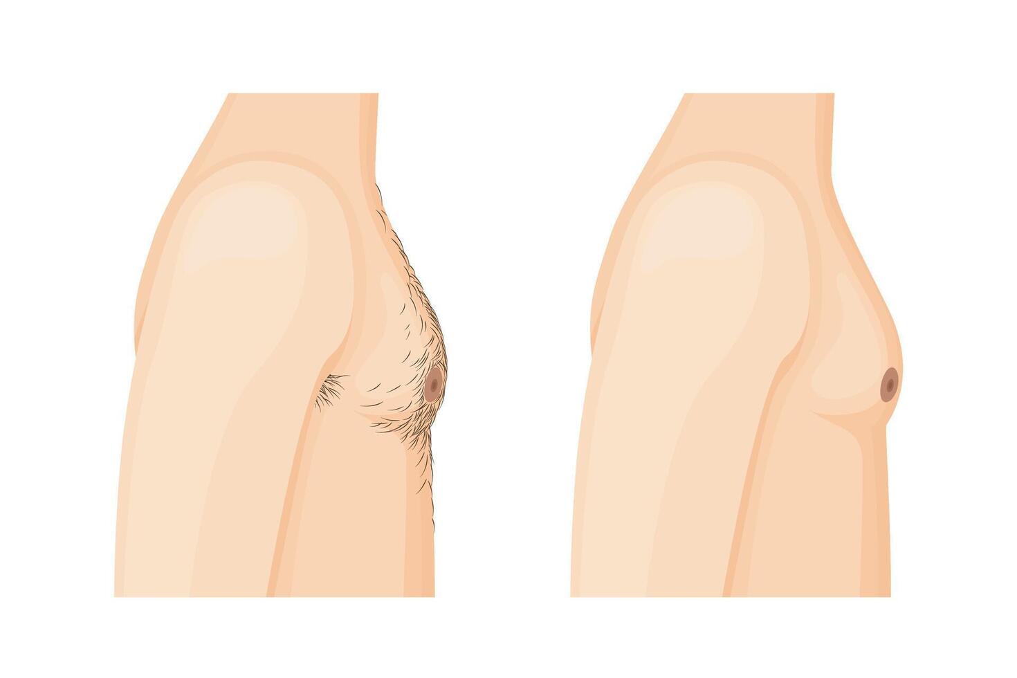 Before and after effects of male torso depilation. Transformation from a hairy to a smooth chest. vector