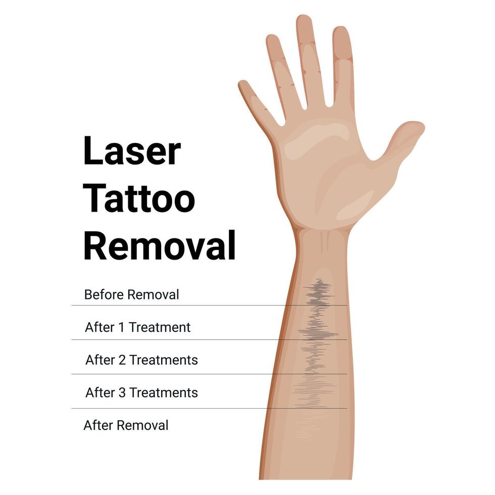 Laser Tattoo Removal Procedure, result before and after vector