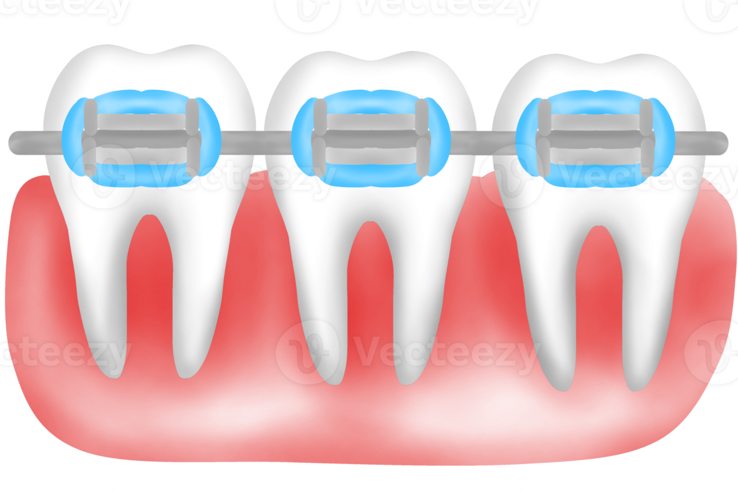 Teeth and gums with braces png
