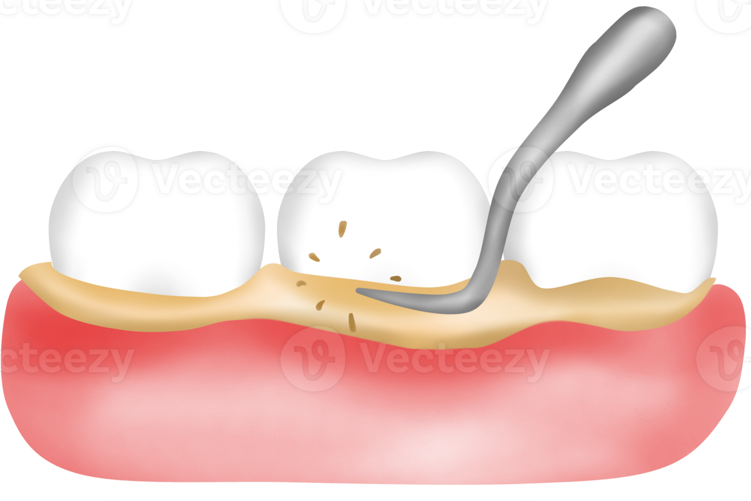 Scaling the gums and teeth png