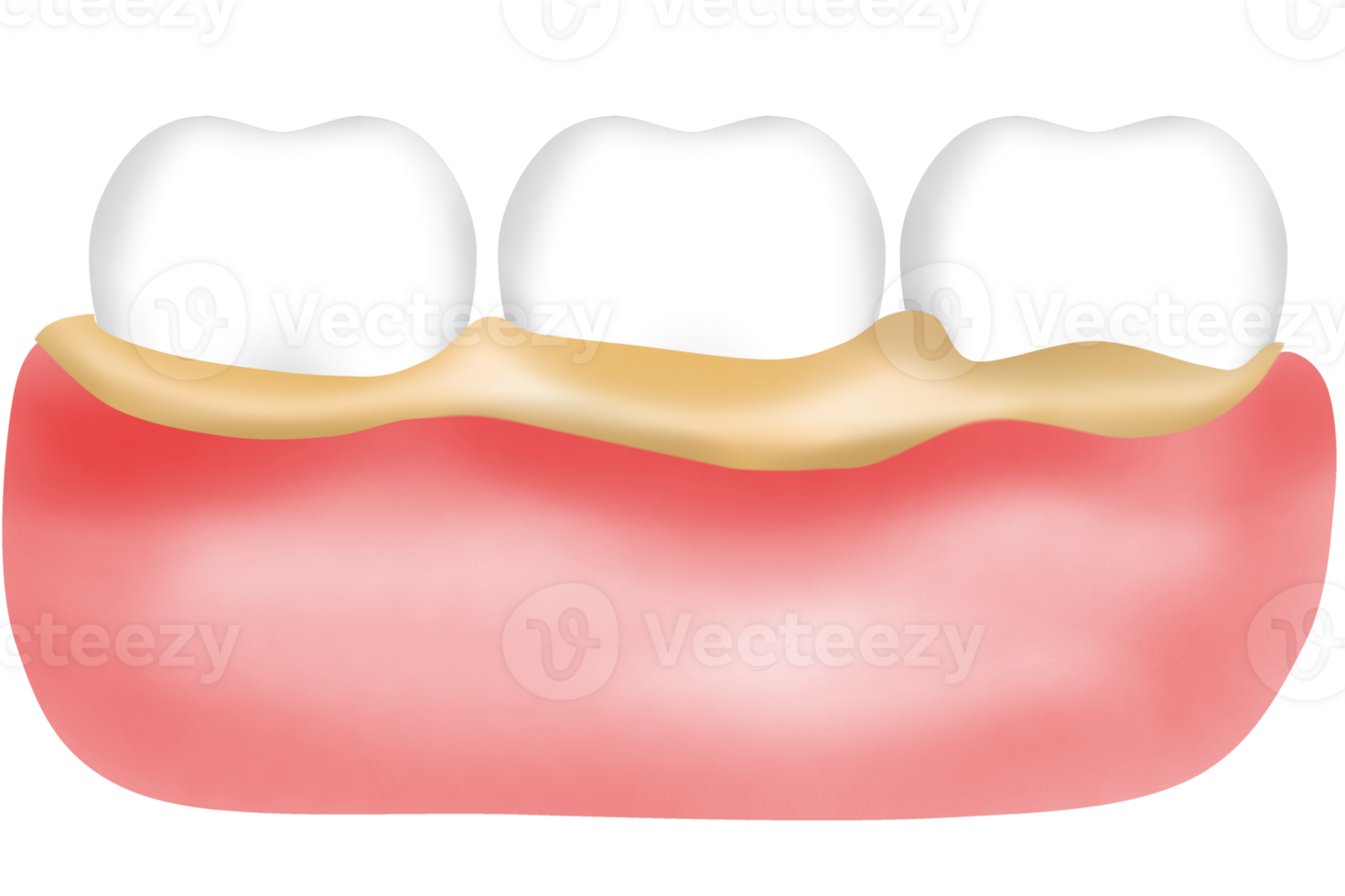 Teeth and gums with tartar Bacteria or plaque adheres png