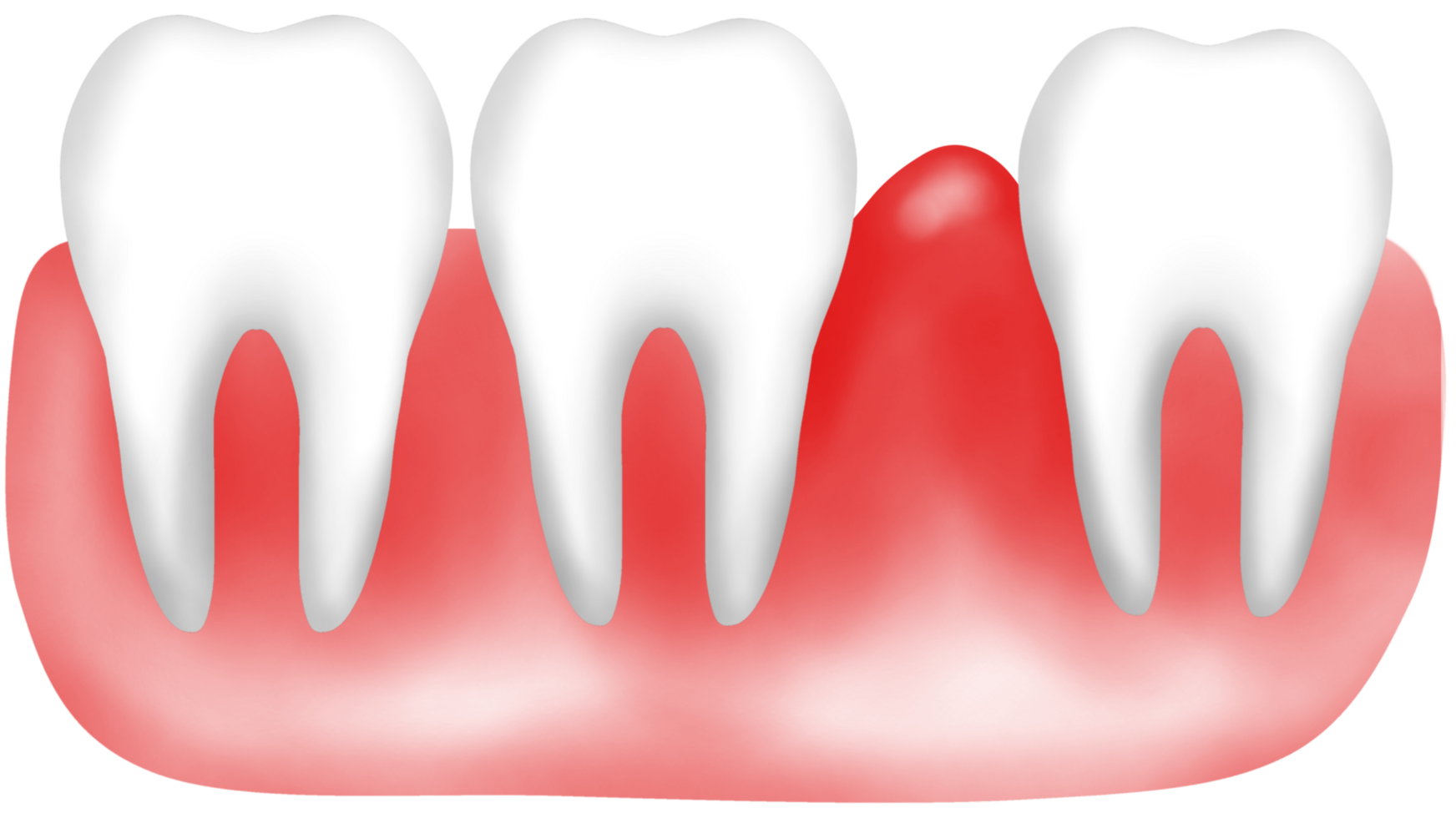 teeth and Swollen red gum due to gum disease png