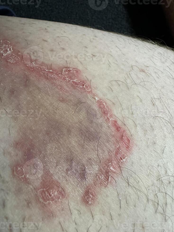 Close-up of Inflamed Skin Condition on Thigh photo