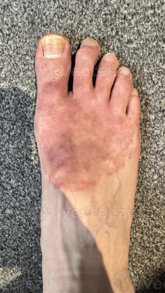 Close-Up of Inflamed Human Foot photo