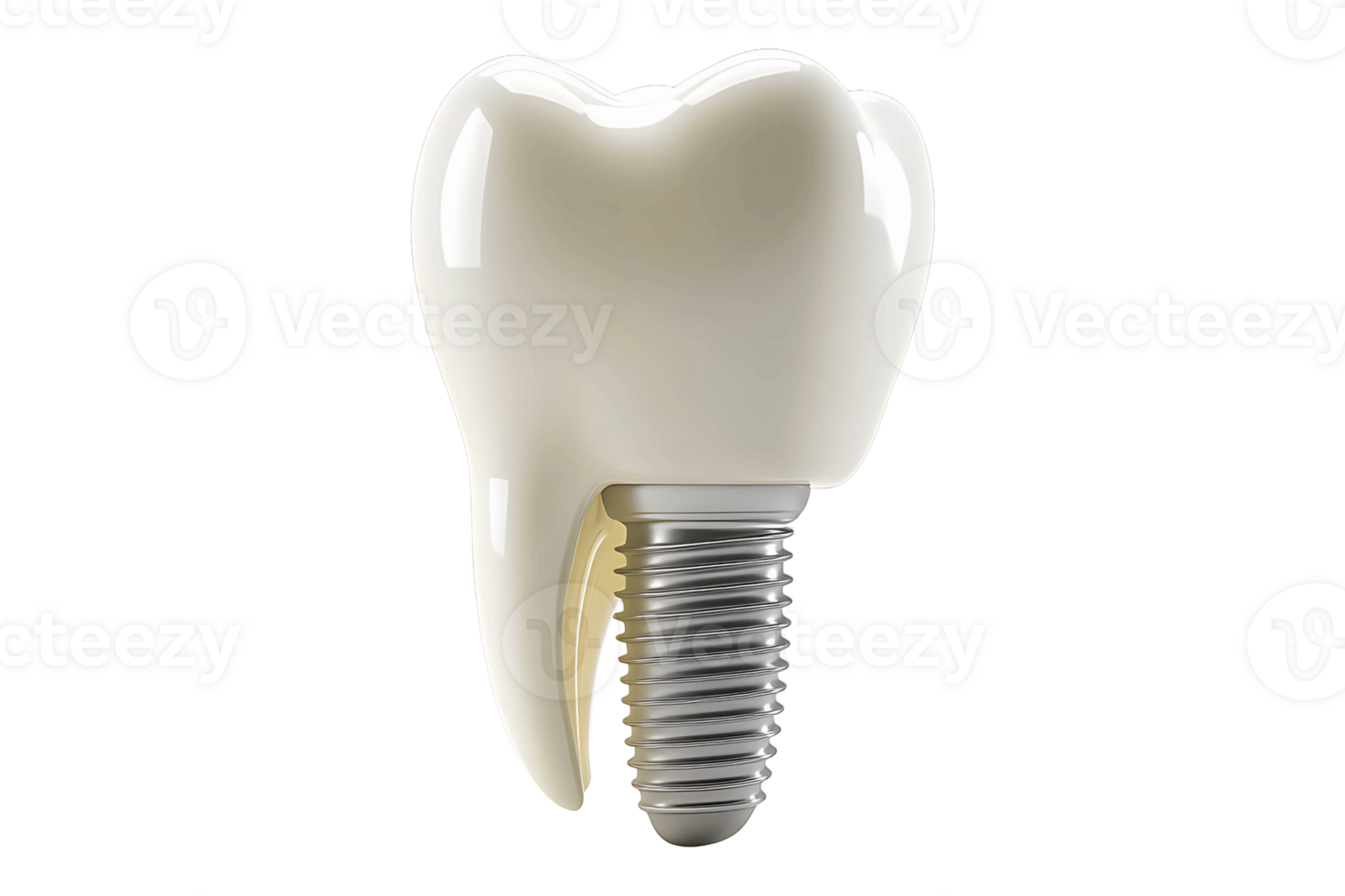 Tooth with implant isolated on transparent background. png